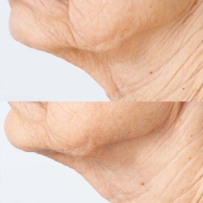 Cold Plasma Plus+ Sub-D/Neck